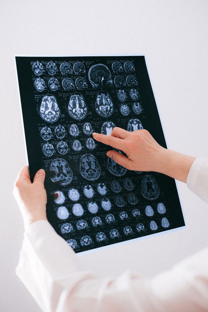 EMT para el TOC: ¿funciona la estimulación magnética transcraneal?